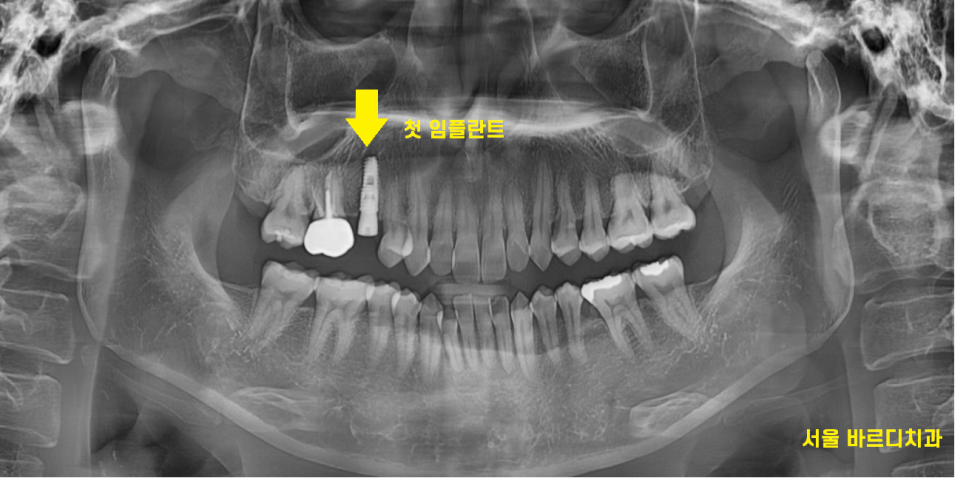 강동구 임플란트 치과 뿌리만 남은 치아 시작이 좋아야 끝도 좋으니까!! 관련 이미지 6