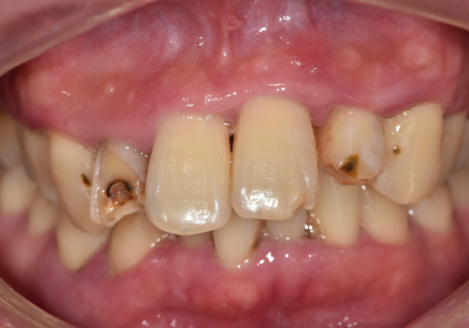 강동구 앞니 충치, 누구는 레진이고 누구는 임플란트인 관련 이미지 1