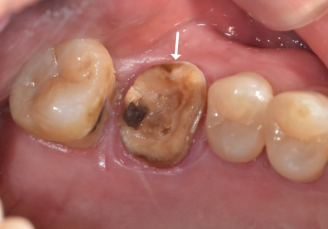 앞니 브릿지 탈락, 씌워둔 게 빠졌어요. 다시 붙일 수 있을까요? 관련 이미지 1