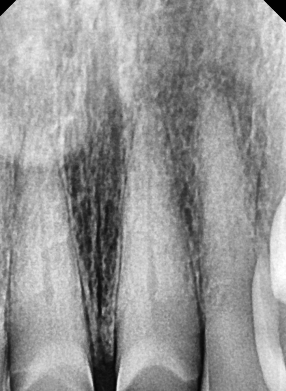 The Moment You Decide on Orthodontic Treatment in Your 50s Is the Fastest image 5
