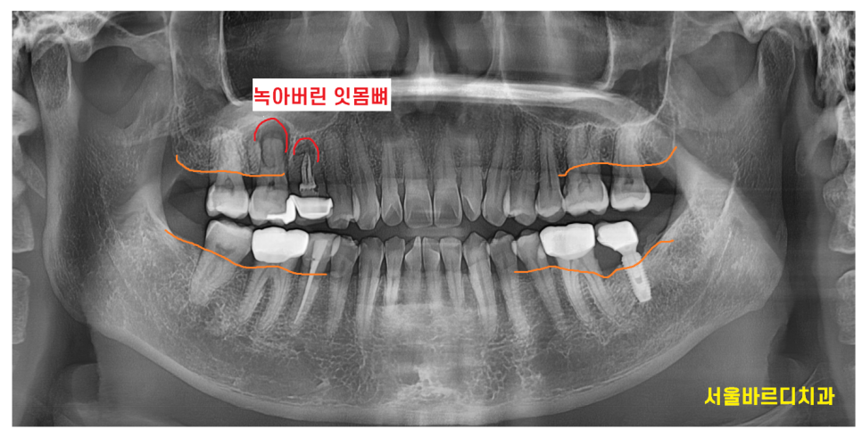 하남시청치과 신경치료 치아 발치 후 임플란트 했습니다. 관련 이미지 1