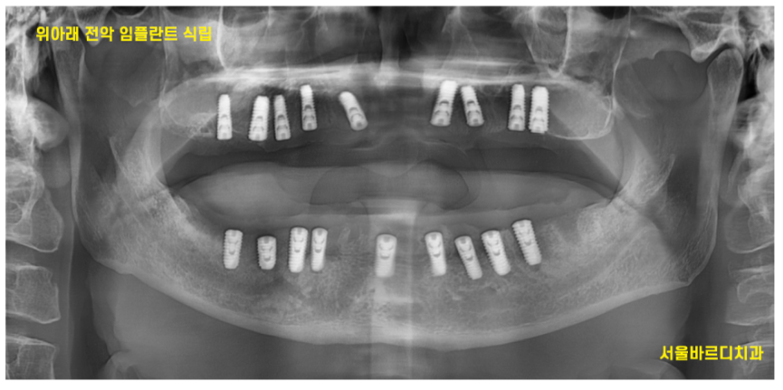 임플란트 뚜껑 빠짐 시공이 잘못된거 아냐? 생각이 들으셨다면 관련 이미지 8