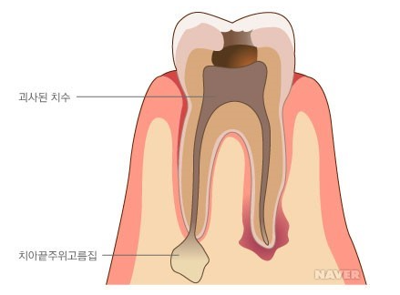 뜨거운 물 시큰 오히려 위험한 신호입니다!! 관련 이미지 2