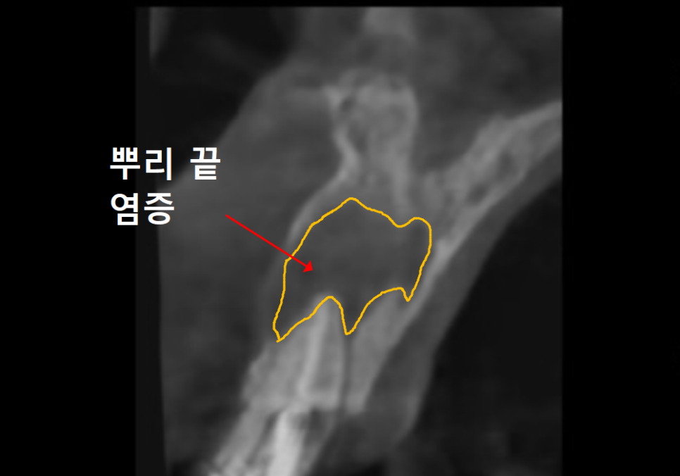 Honestly, Can an Unbroken Temporary Tooth Be Used Without a Crown? image 8