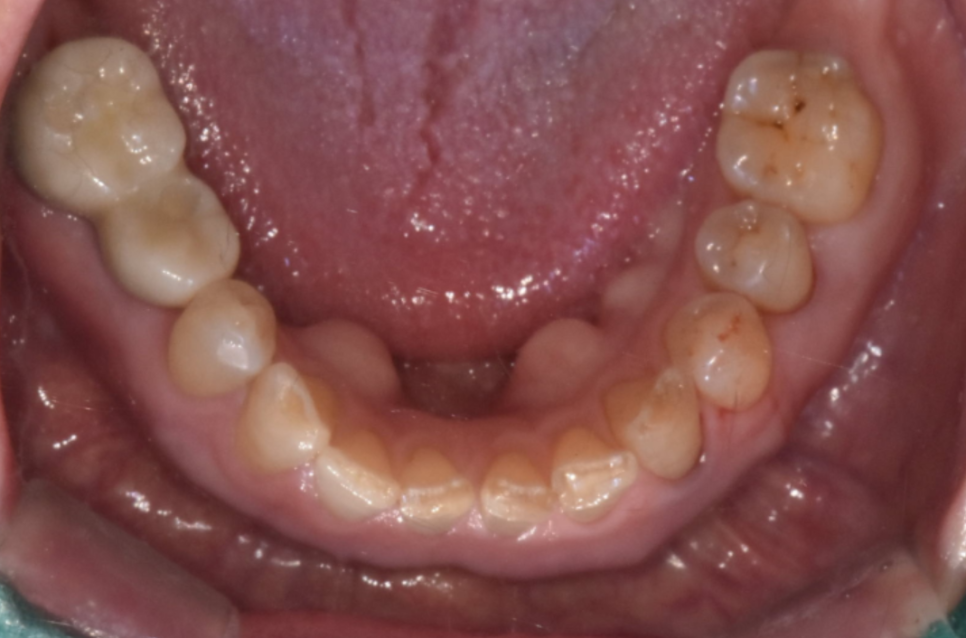 임플란트 볼씹힘 왜 생기고 어떻게 해결할까? 관련 이미지 5