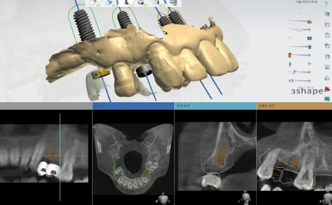 고덕동치과, 보험 임플란트? 추가 비용이 왜 나오는 거죠? 관련 이미지 9
