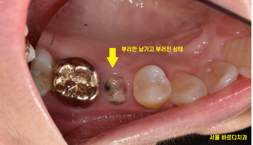 강동구 임플란트 치과 뿌리만 남은 치아 시작이 좋아야 끝도 좋으니까!! 관련 이미지 2