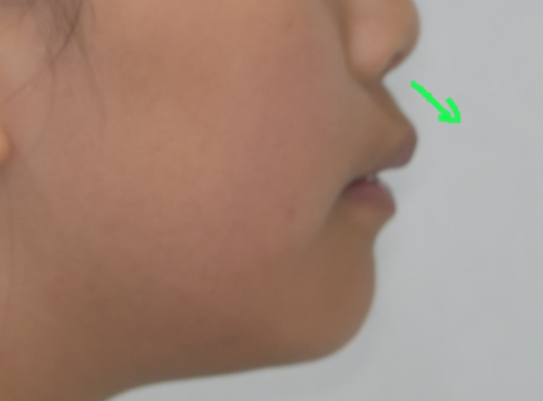 How to Correct a Canine Crowding Malocclusion: Extractions Are Necessary to Address Lip Protrusion image 5