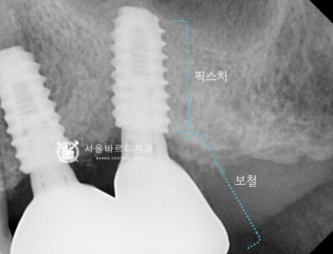 고덕동치과 서울바르디치과 무절개 네비게이션 임플란트 치료증례 #1 관련 이미지 16