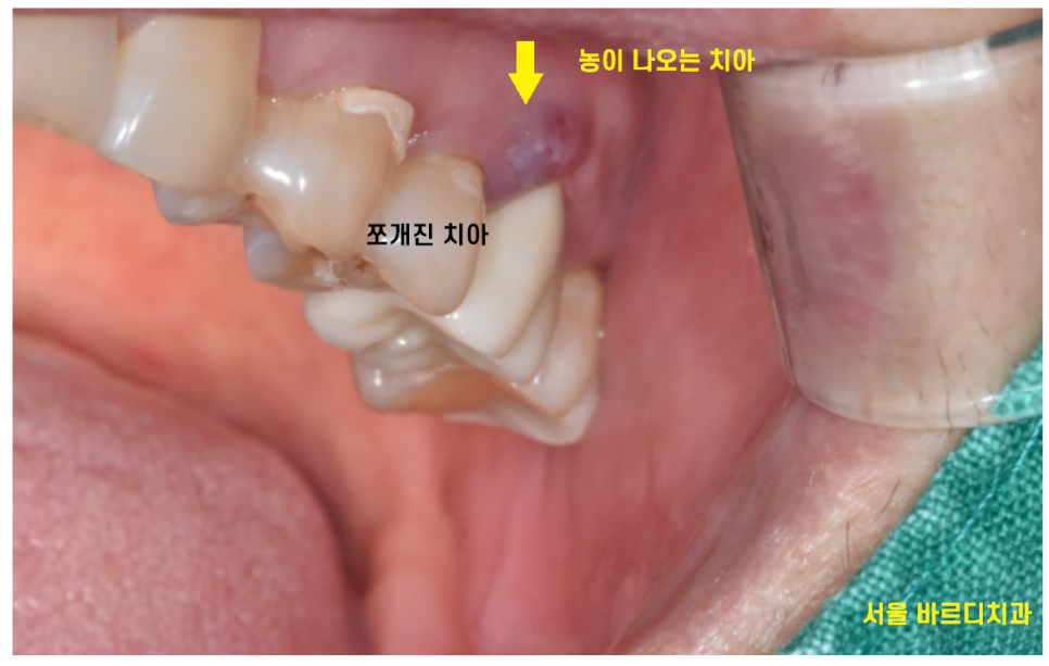치아 쪼개짐으로 상악동 거상술 동반한 임플란트 수술 관련 이미지 4