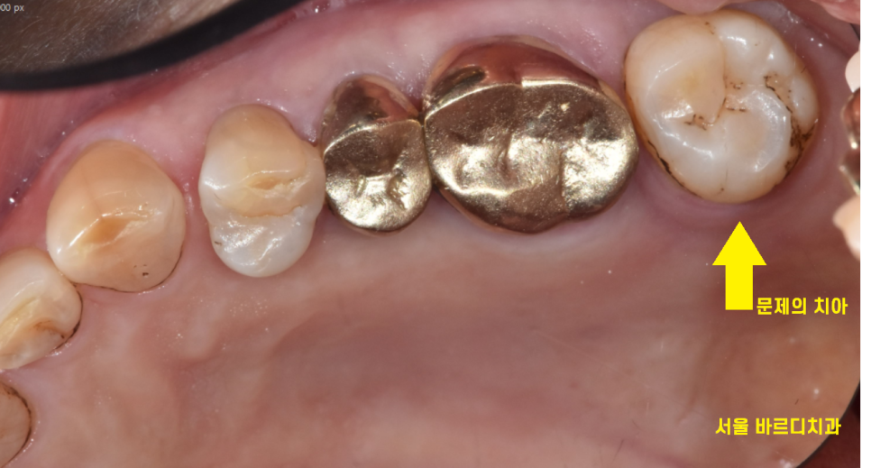 고덕동 치과 임플란트 거부감이 있었지만 네비게이션 수술법으로 해결했습니다. 관련 이미지 3