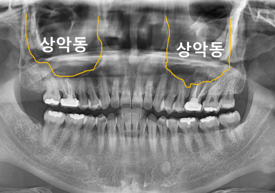 Sinusitis Caused by Teeth: Why Do You Tell Me to Go to the Dentist When My Nose Hurts? image 1