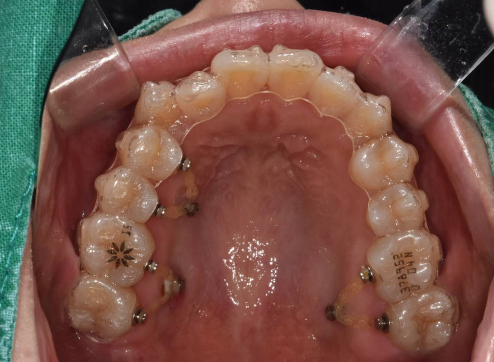 투명교정장치 착용 20시간 이상 할 자신이 없다면 고민해보세요! 관련 이미지 5