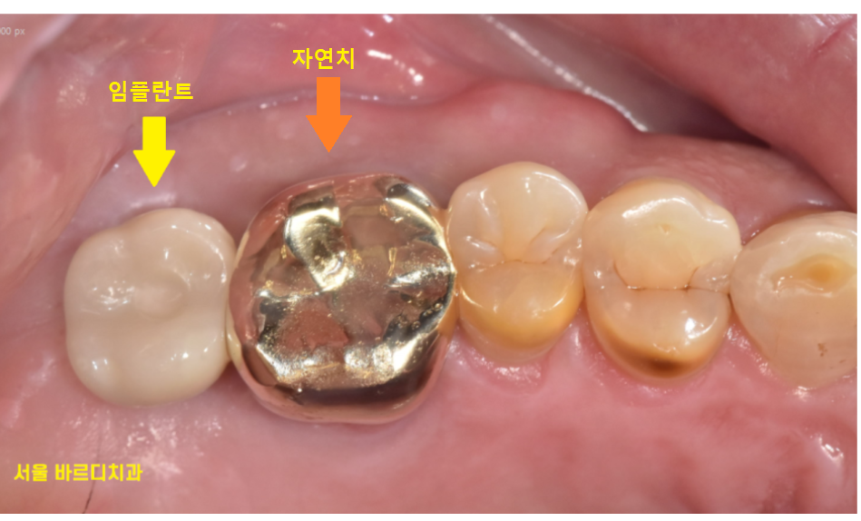 고덕역 근처 치과 임플란트 크라운 크기 크면 다 좋을까요?? 관련 이미지 2