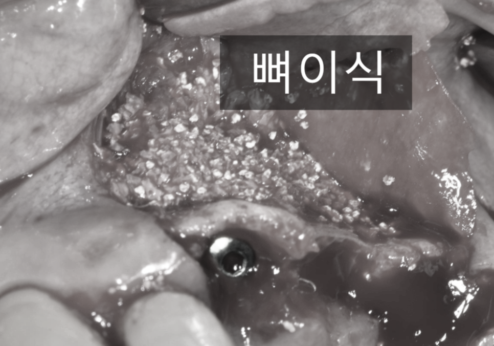 고덕동 임플란트, 튀어나온 앞니, 비용은 줄이고 자연스럽게 개선한 실제 사례 관련 이미지 7