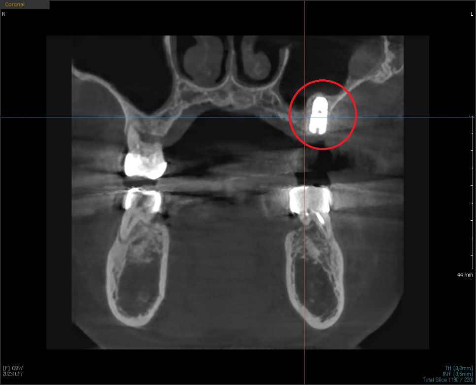 고덕동치과 서울바르디치과 무절개 네비게이션 임플란트 치료증례 #2 관련 이미지 15
