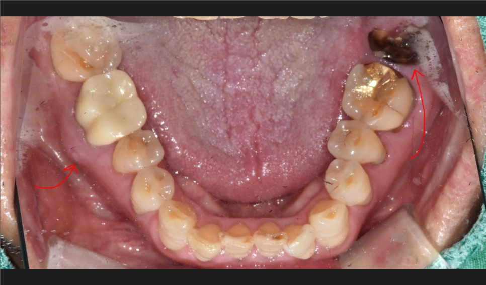 바르디 임플란트는 바르게 심지만, 빠르게 씹습니다. 그간의 경험을 바탕으로요. 관련 이미지 4