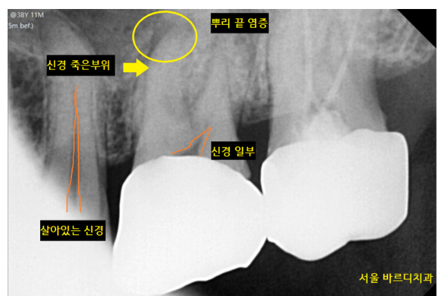 상일동치과 비가역적 치수염 치아 심폐소생했습니다. 관련 이미지 3