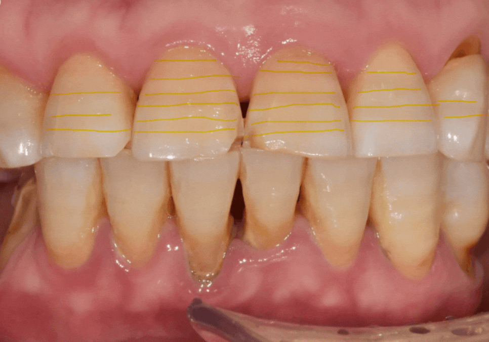 앞니 끝부분 깨짐, 다듬기, 레진, 라미네이트? 어떤 치료가 나에게 적합할까? 관련 이미지 8