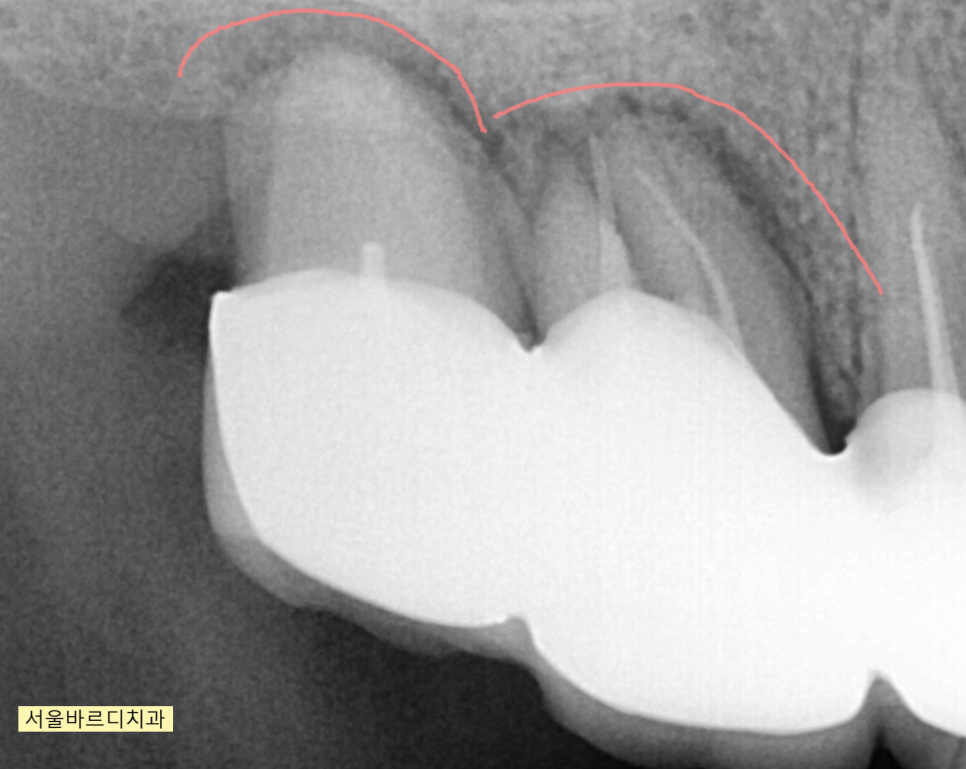 위아래 임플란트 동시에 하여 치료기간 단축하기 관련 이미지 3