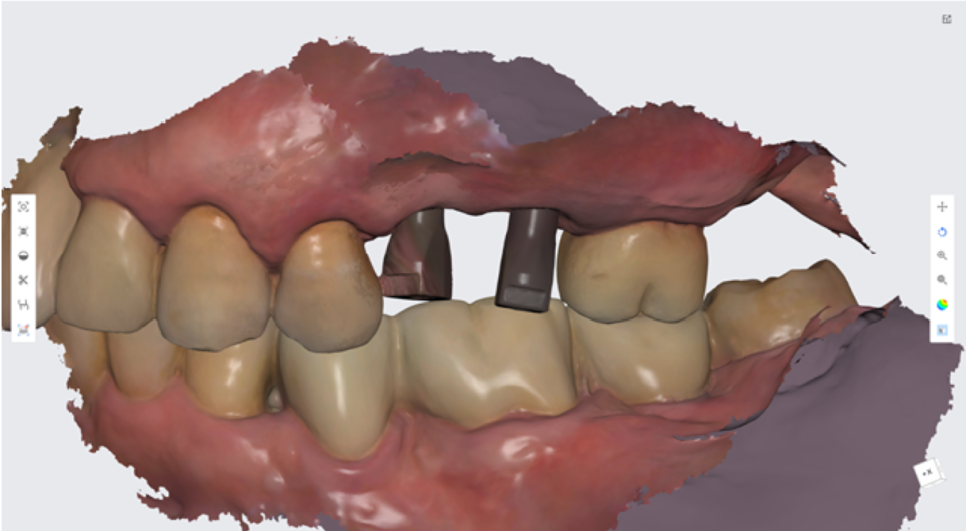 고덕동치과 서울바르디치과 전치부 및 구치부 임플란트 치료증례 #9 관련 이미지 34