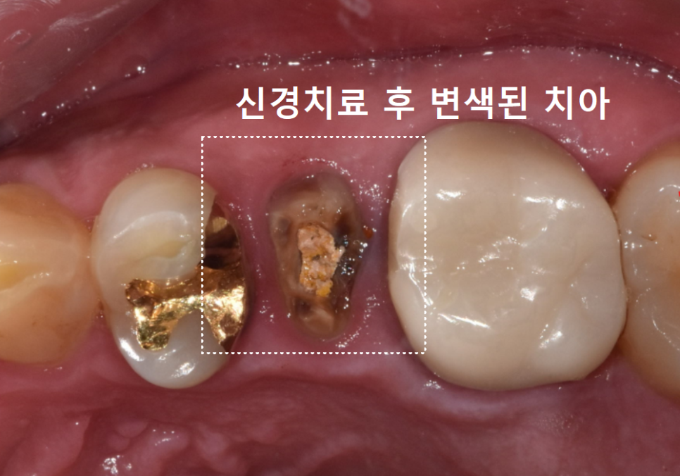 명일동 치과, 잇몸이 검게 변했다면? 앞니 변색 원인은 바로 관련 이미지 6