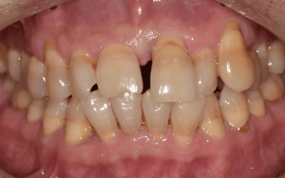 잇몸 내려감으로 길어진 치아, 방치하면 안 되는 원인, 증상, 이유 관련 이미지 4