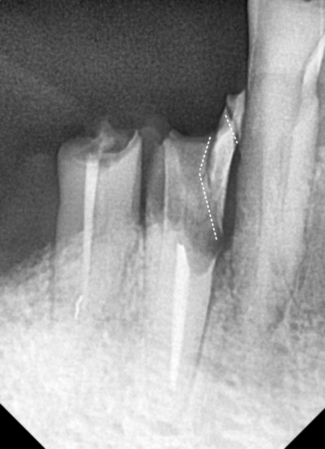 오래된 어금니 롱브릿지, 교체 타이밍을 놓치면 관련 이미지 7