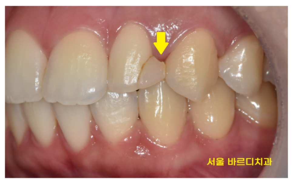 살짝 깨진 앞니 레진과 라미네이트 갈림길 어떤게 더 좋을까? 관련 이미지 5