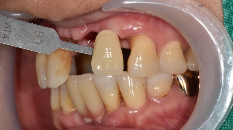 미사 임플란트 보철 새로하고 연결했습니다. 관련 이미지 8