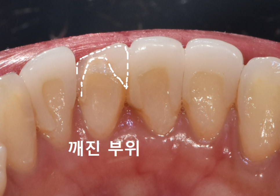 앞니 라미네이트 교체, 재시술 전 꼭 알아야 할 실패를 줄이는 방법 관련 이미지 7