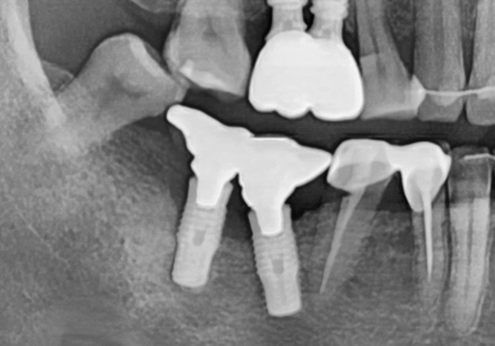 오래된 임플란트, 흔들림과 통증, 어떻게 하면 더 건강하게 쓸 수 있을까? 관련 이미지 11