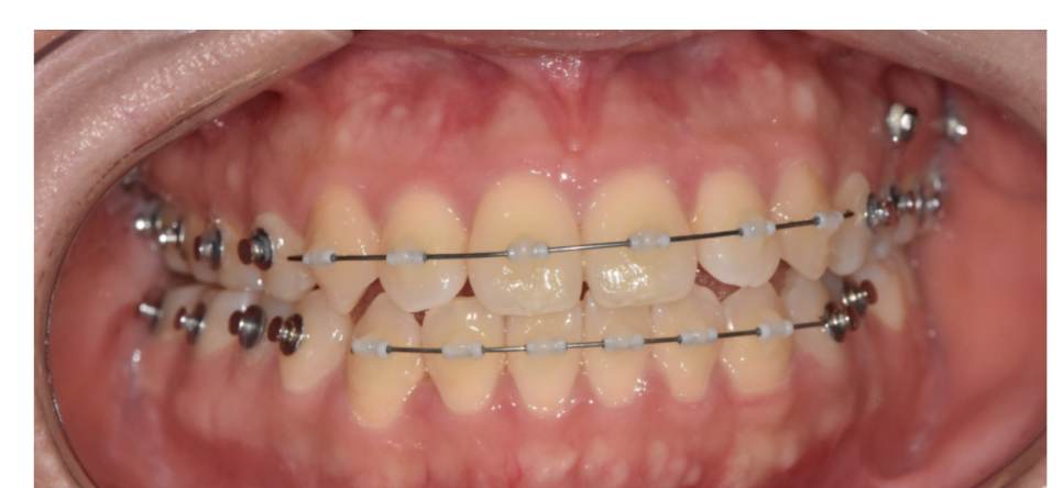 성인 치아교정 기간 평균 2년이 소요되는 까닭은? 관련 이미지 3