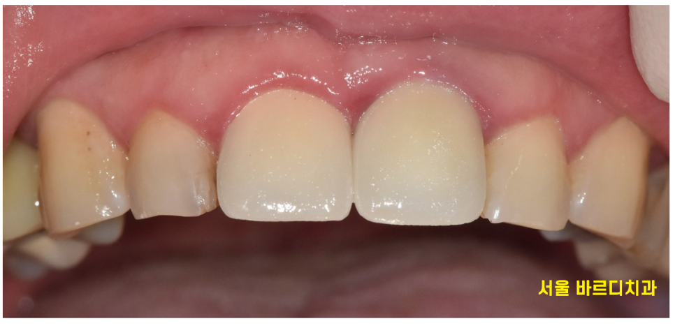 살짝 깨진 앞니 레진과 라미네이트 갈림길 어떤게 더 좋을까? 관련 이미지 7