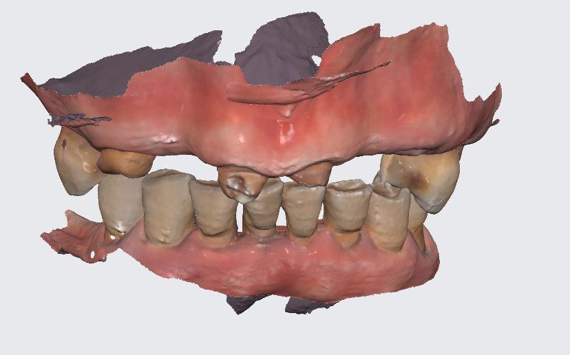 강동구 임플란트 어금니 상실 방치하다 치매까지 옵니다. 관련 이미지 2