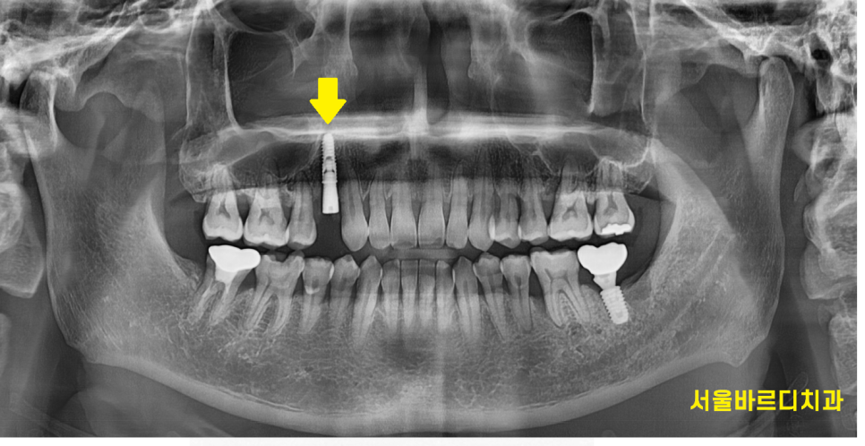 상일동역 치과 잇몸 뼈 녹음 임플란트 케이스 관련 이미지 6