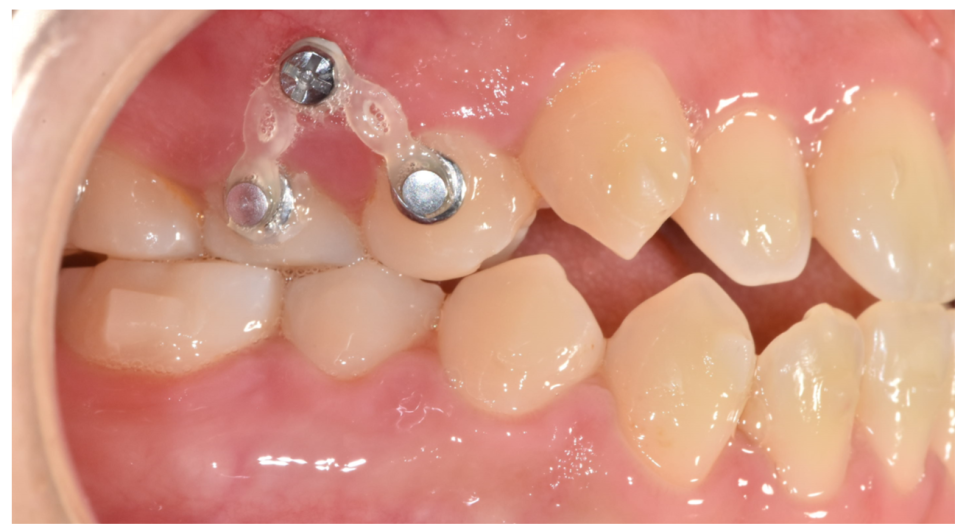 치아 교정 스크류 통증 의외로 이렇습니다. 관련 이미지 2