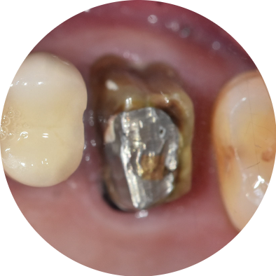 크라운 탈락 빠짐, 빠졌을 때 그대로 다시 붙일 수 있나요? 관련 이미지 1