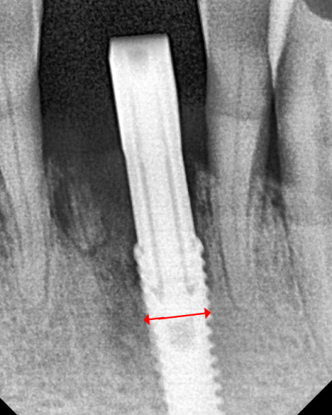 강동구 임플란트 가격 줄이는 방법 2개 발치했는데, 1개만 심어도 된다구요? 관련 이미지 9