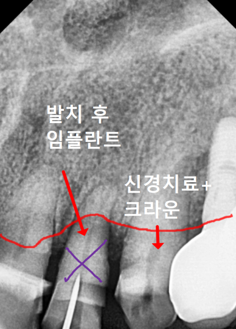 고덕역치과, 잇몸 패임(치경부 마모) 레진 치료, 왜 자꾸 떨어지나요? 관련 이미지 8