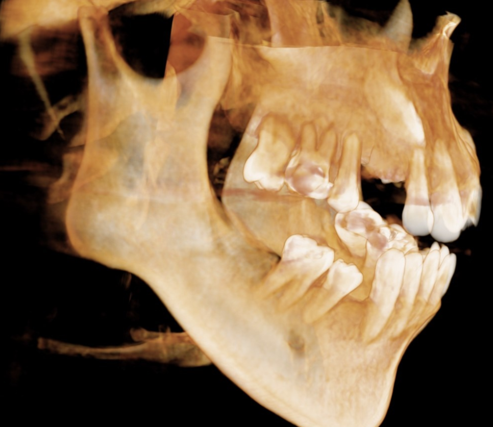 치아교정 턱관절 연관이 있기에 고덕역 치과에서는 이렇게 합니다. 관련 이미지 5