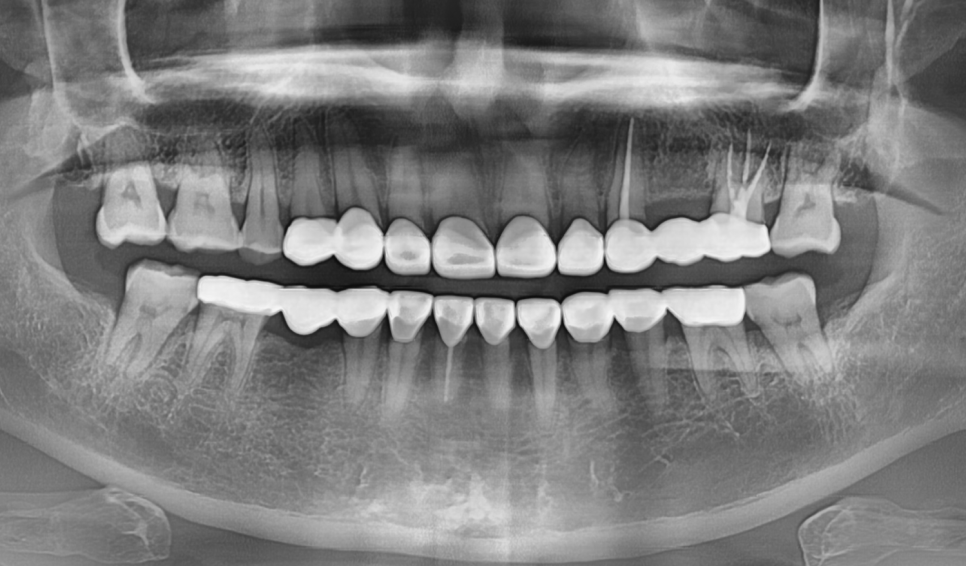 누런 치아 연예인치아 처럼 하얗게 만들 수 있나요? 관련 이미지 11