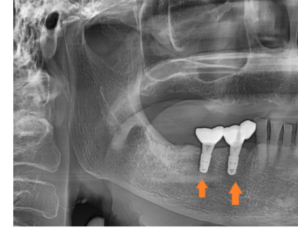 강동구 임플란트 수술 전 확인하면 좋을 3가지 관련 이미지 5