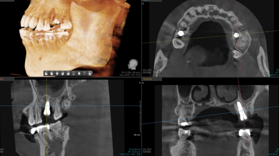 발치후 임플란트 시기 기다려야할까 바로 해야할까? 관련 이미지 5