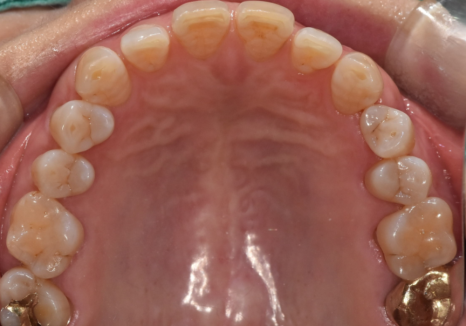 명일동 라미네이트 vs 크라운, 수명을 좌우하는 선택 기준 3가지 관련 이미지 6