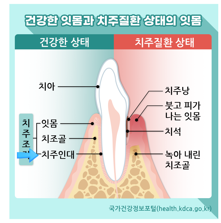교정 치아 흔들림 걱정하고 계신 환자분께 드리는 편지 관련 이미지 4