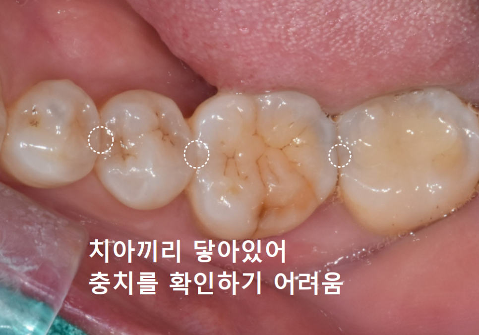 고덕동 어금니 사이 충치, 양치질 누구보다 열심히 하는데 왜 자꾸 생길까요? 관련 이미지 2