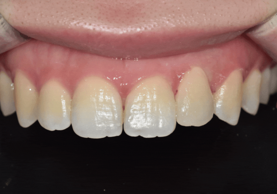 상일동역 라미네이트, 왜 누군가는 부작용을 겪고, 누군가는 10년 넘게 멀쩡할까? 관련 이미지 8