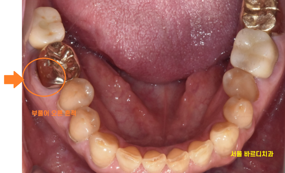 미사역 임플란트 잇몸이 풍선처럼 부풀어오르는 치주농양 환자분 관련 이미지 3