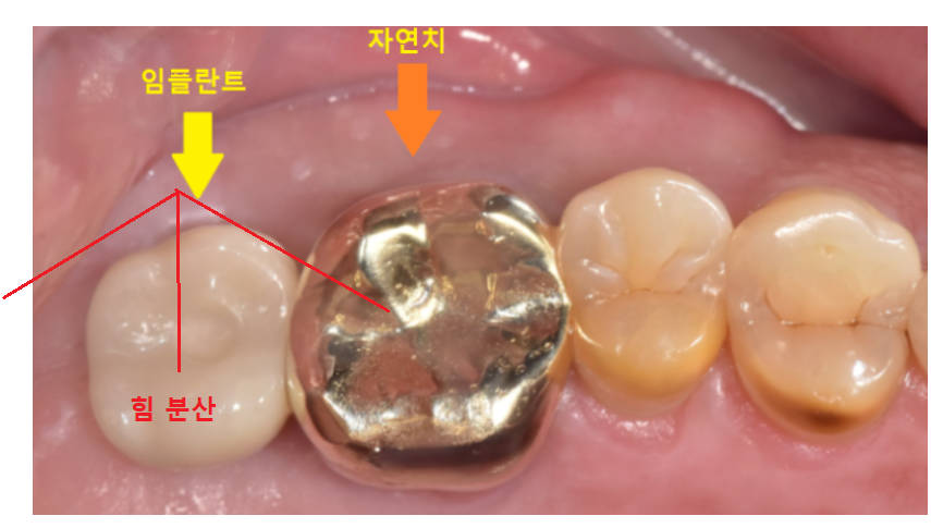 고덕역 근처 치과 임플란트 크라운 크기 크면 다 좋을까요?? 관련 이미지 8